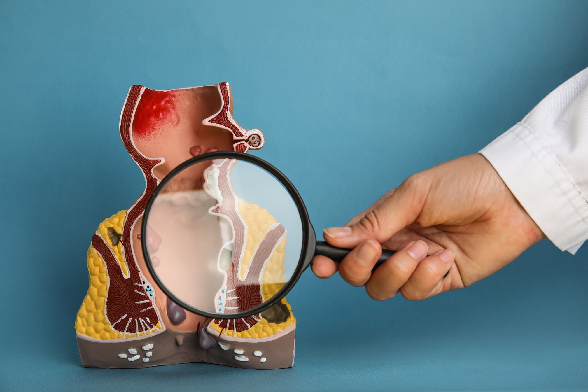 Proctologist Holding Magnifying Glass near Anatomical Model of  with Hemorrhoids on Light Blue Background, Closeup